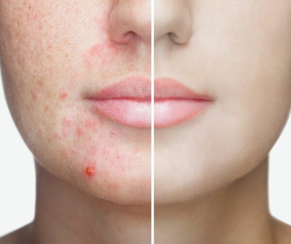 acne behandeling cleyo beauty professional