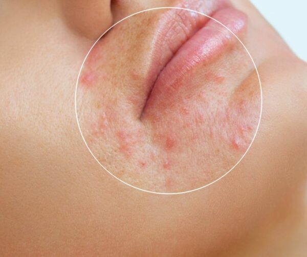 acne behandeling cleyo beauty professional