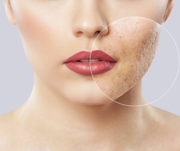 acne opleiding cleyo beauty professional