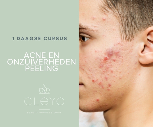 acne peeling cursus opleiding cleyo beauty professional